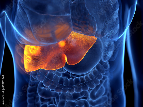 3d rendered illustration of liver cancer