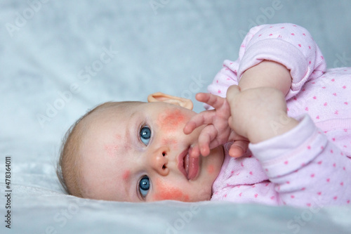 Scarlet fever. Little girl face coverd with many red pimples.