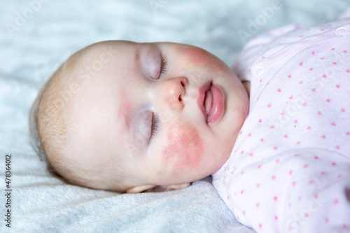 Little girl with atopic dermatitis on face
