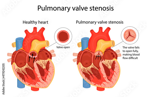 pulmonary valve stenosis. anatomical illustration