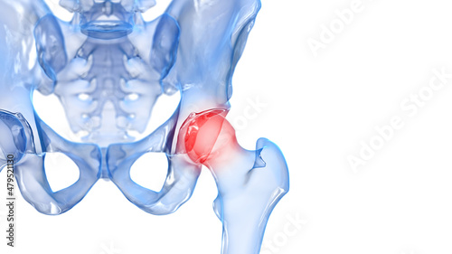 3d rendered illustration of a painful hip joint