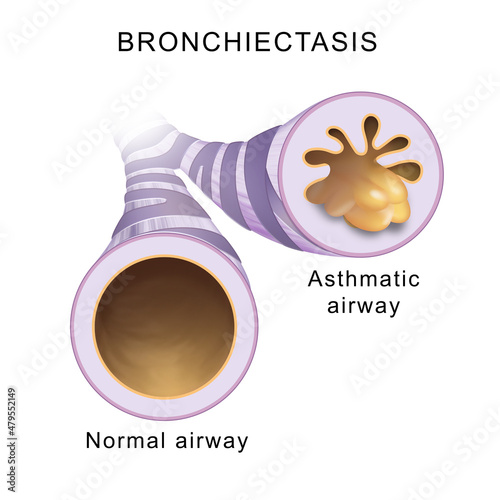 Bronchiectasis. Normal airway and asthmatic airway