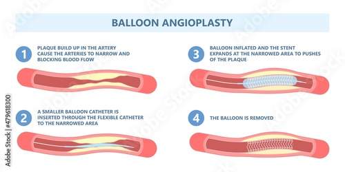 Angiography medical operation Angiogram Biopsy Angioplasty Stent Congenital Heart Defect Ablation CAG arteries plaque X-ray flow diagnose diagnosis blocked CABG valve atrial attack afib infarction