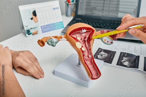 Gynecologist showing polyps of endometrium of uterus using anatomical model during consultation to female patient. Gynecology, treatment of uterine polyps