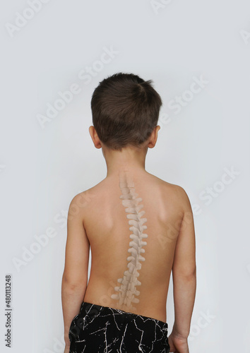 Scoliosis Spine Curve Anatomy, Posture Correction. Child with a deviated spine