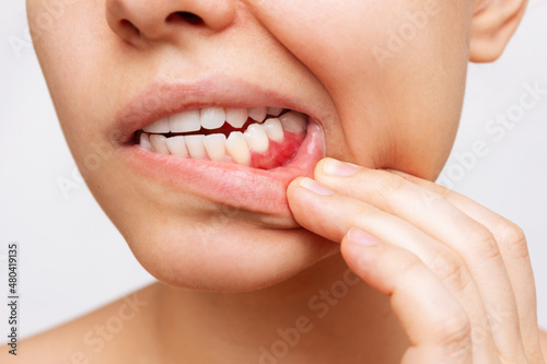 Gum inflammation. Cropped shot of a young woman showing red bleeding gums isolated on a white background. Close up. Dentistry, dental care 