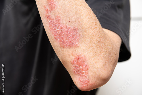 Acute psoriasis on elbows, knee is an autoimmune incurable dermatological skin disease. Large red, inflamed, flaky rash on the knees. Joints affected by psoriatic arthritis