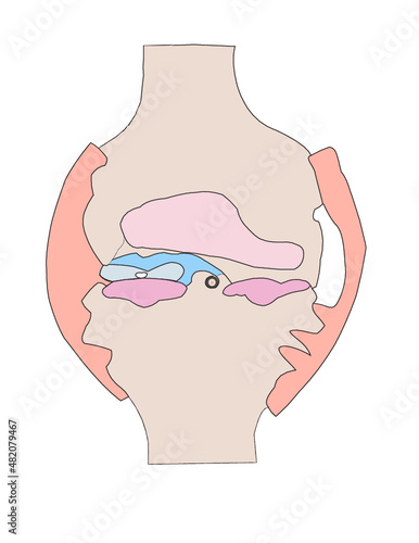Knee in Rheumatoid Arthritis with Pannus formation 