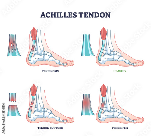 Achilles tendon injury as leg or ankle trauma outline diagram. Labeled educational inflammation and orthopedic ligament conditions vector illustration. Tendinosis, rupture and tendinitis problem.