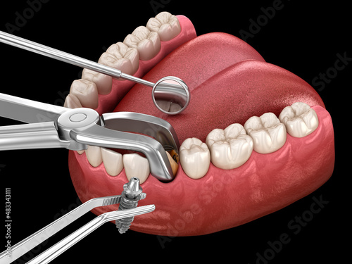 Extraction and Implantation, complex immediate surgery. Medically accurate 3D illustration of dental treatment