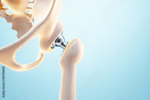 Medical poster image of a hip implant. artificial joint, Arthritis, inflammation, fracture, cartilage. 3D illustration, 3D render.