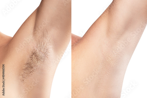 Comparison of female armpit after hair removal