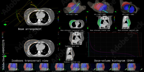 The overview shows beam configurations, dose calculations and dose distributions for postoperative radiotherapy of a breast cancer patient.