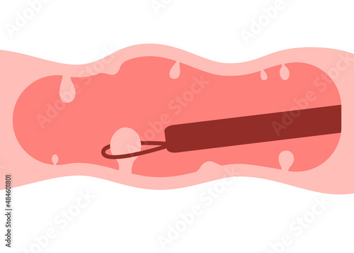 Colonoscopy intestine, polypectomy procedure, removal polyp in colon. Checkup gut, colon surgery. Operation intestine. Vector illustration