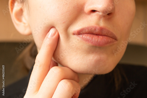 Young woman points her finger at her lips infected herpes virus. Indignation look. Diseases of the immune system.