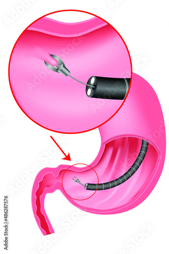 Biopsy of the stomach. Taking a sample of the mucous membrane for research. Introduction of the endoscope through the esophagus. Gastroscopy. Vector illustration