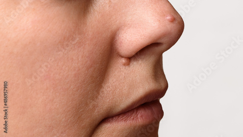 Closeup of two big moles or nevus on face. Nevi on nose of woman. Mole check and skin cancer prevention concept.