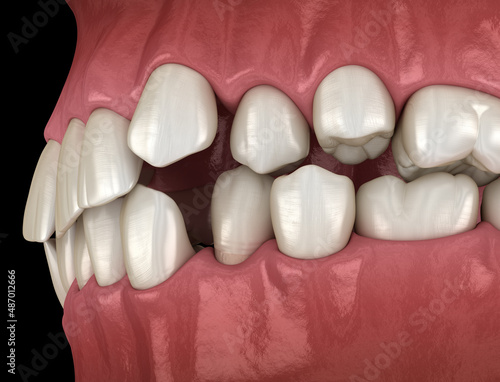 Overcrowded teeth, abnormal dental occlusion. Medically accurate tooth 3D illustration