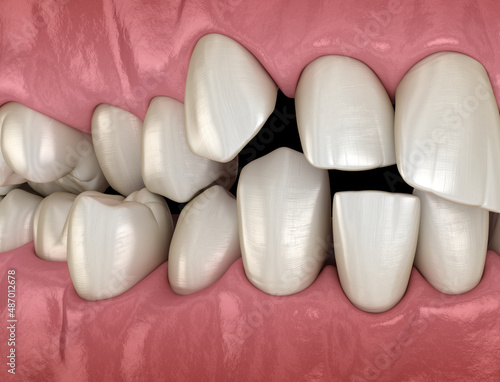 Overcrowded teeth, abnormal dental occlusion. Medically accurate tooth 3D illustration