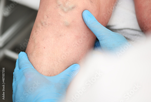 hlebologist examines a patient with varicose veins on his leg.