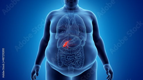 3d rendered illustration of an obese mans gallbladder