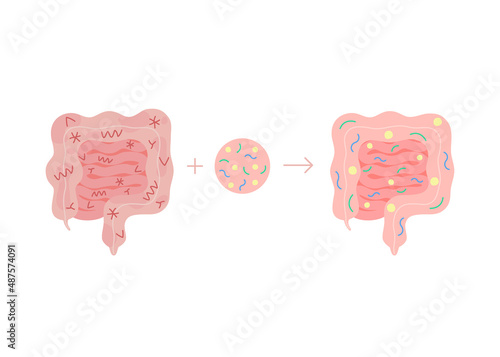 Fecal microbiota transplant from healthy in unhealthy intestine, FMT. Improvement intestinal microflora and normalization stool by introducing beneficial bacteria in bowel colon tract. Vector