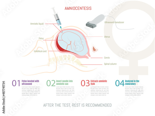 Amniocentesis procedure, to detect or rule out hereditary disorders in the fetus.
