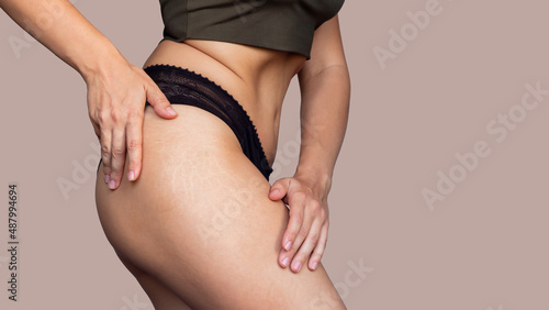 Close-up of a female thigh with white stretch marks from a sharp weight loss or weight gain isolated on a beige background. Changes in the body