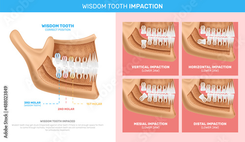 Wisdom Tooth Impaction Infographics