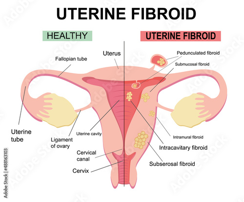 Types of uterine fibroids. Disease of the female reproductive system. Reproductive system picture displays pedunculated, intracavitary, submucosal, subserosal. Flat illustration of myoma, leiomyomas.