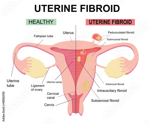 Types of uterine fibroids. Disease of the female reproductive system. Reproductive system picture displays pedunculated, intracavitary, submucosal, subserosal. Flat illustration of myoma, leiomyomas.