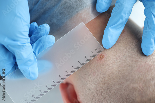 Dermatologist doctor examine patient mole in dermatology clinic