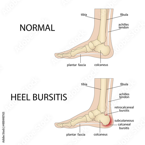 Calcaneal bursitis. Foot with normal heel and foot with Haglund's deformity and bursitis