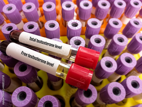 Blood sample tubes with sample for Testosterone(Total and Free) test. Healthcare or medical concept. Male sex hormone, lavender test tube background.