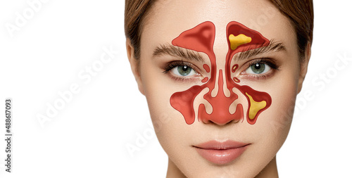 Sinusitis, frontitis. Female face with inflammation of mucous membrane of paranasal and frontal sinuses