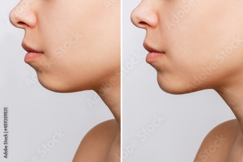 Сhin reduction. Cropped shot of woman's face with chin before and after mentoplasty isolated on a gray background. The result of cosmetic plastic surgery. Profile. Beauty concept