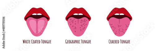 Tongue problems. White coated Cranched, Geograohic tongue. Oral thrush. Candidiasis on the tongue. Fungus in the mouth. Vector