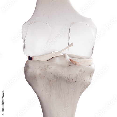 3d rendered medically accurate illustration of a torn lateral miniscus