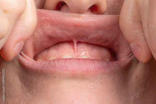 Macro of upper lip frenulum of a mouth of a woman