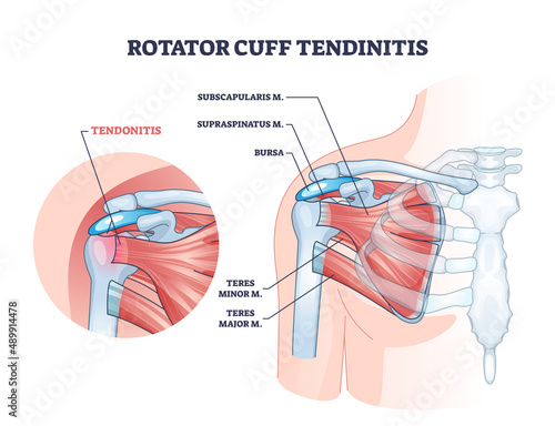 Rotator cuff tendinitis as shoulder muscular inflammation outline diagram. Labeled educational anatomical structure and medical description with body muscle injury and pain cause vector illustration.