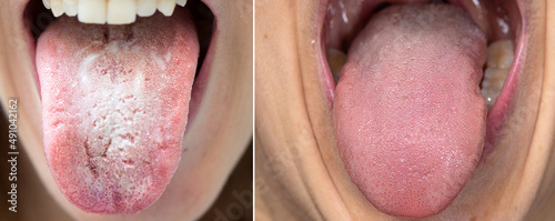Comparison between a tongue with candidiasis and a healthy tongue
