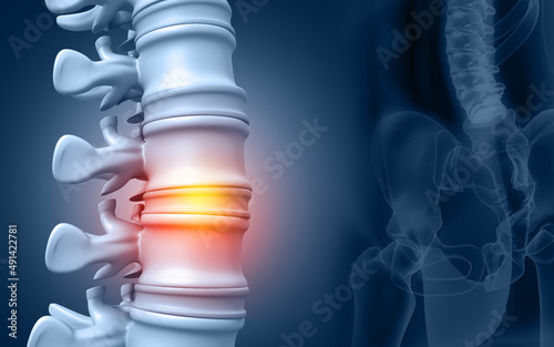 Lumbar intervertebral spine hernia. 3d illustration