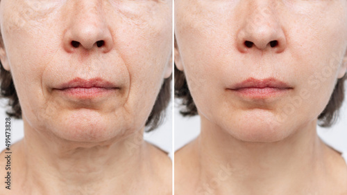 Lower part of face and neck of elderly woman with signs of skin aging before after facelift, plastic surgery on white background. Age-related changes, flabby sagging skin, wrinkles, creases, puffiness