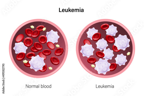 Leukemia. The difference of blood leukemia and normal blood. Red blood cells, White blood cells and platelets.