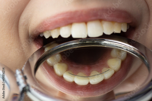 Closeup of a permanent bonded retainer on upper teeth.