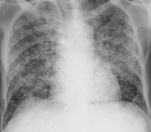 miliary nodules chest Xray 