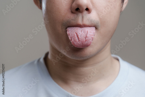 A man sticking out Fissured tongue, Bacterial infection disease tongue,The tongue is thrush.Tongue wound