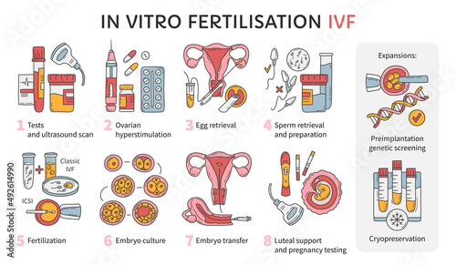 In Vitro fertilization IVF vector infographic and infertility treatment scheme. Ovarian hyperstimulation, artificial insemination, embryo culture and cryopreservation. Medical procedure for pregnancy