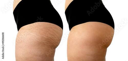 Image compare before and after Woman legs and buttocks with stretch marks removal treatment isolated on white background.
