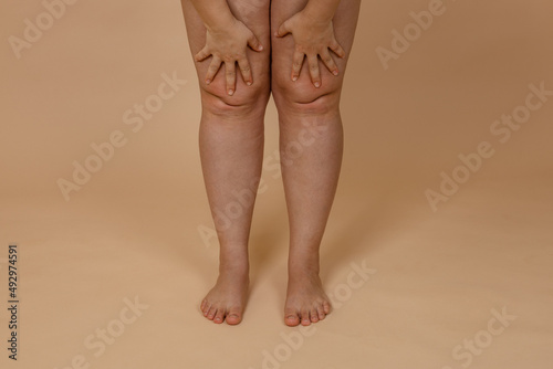 Cropped photo of woman bare naked legs, pinching fat on knees. Clipping fat folds. Removal of fat knees, liposuction of edematous skin. Varicose vein, dehydrated thick skin. Body care. Fat loss